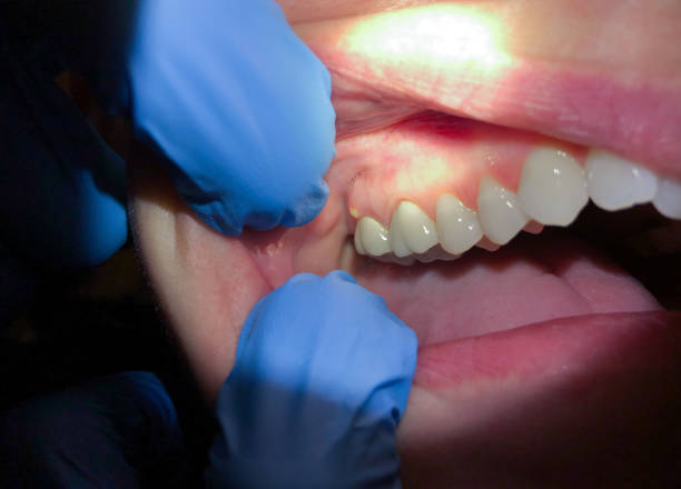 Best Emergency Dental Care for Abscessed Tooth in Overlea, MD